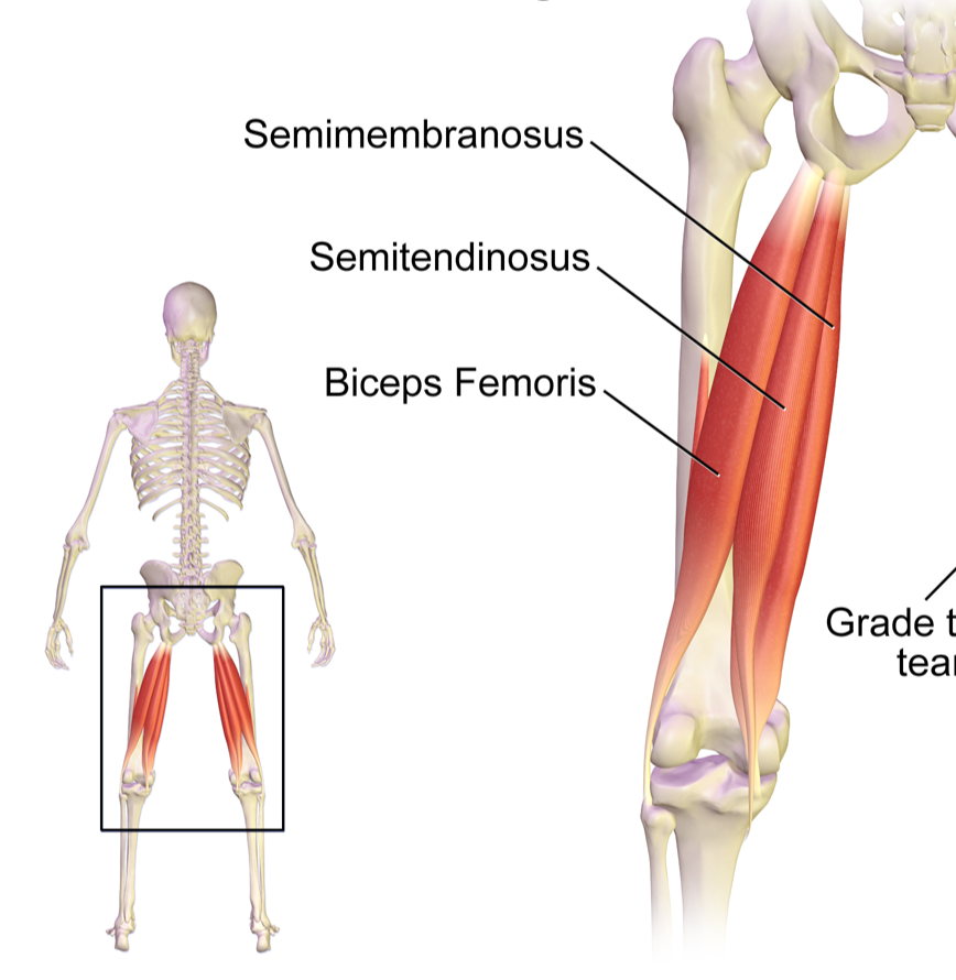 Pulled_Hamstring (1).png