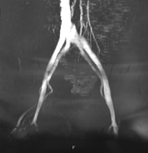 MRV image of iliac veins